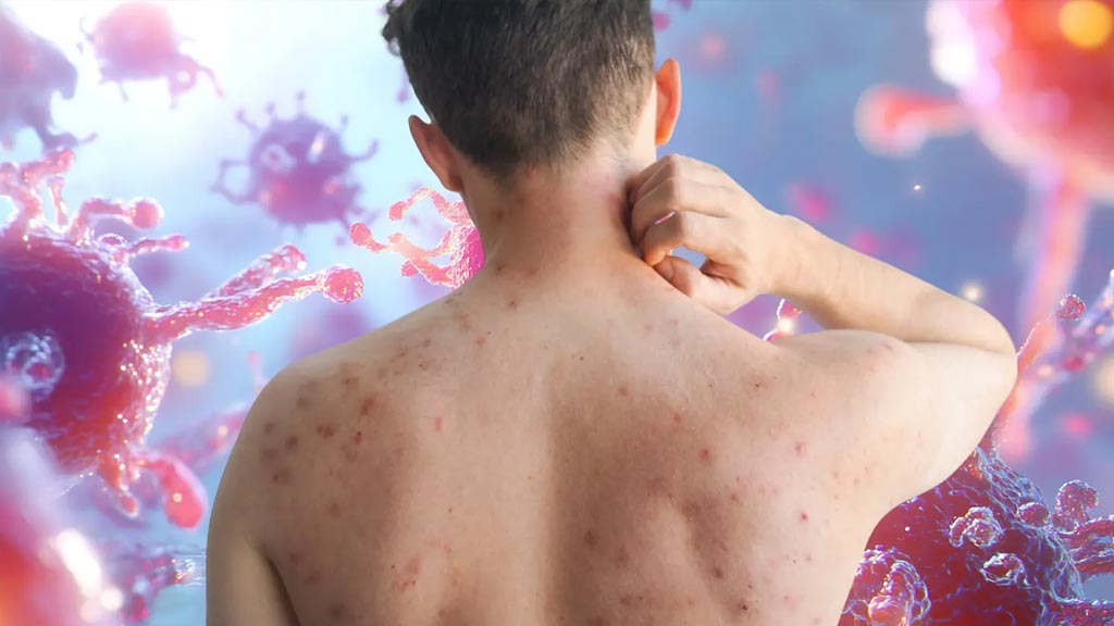 Descartan casos de sarampión en Huajuapan